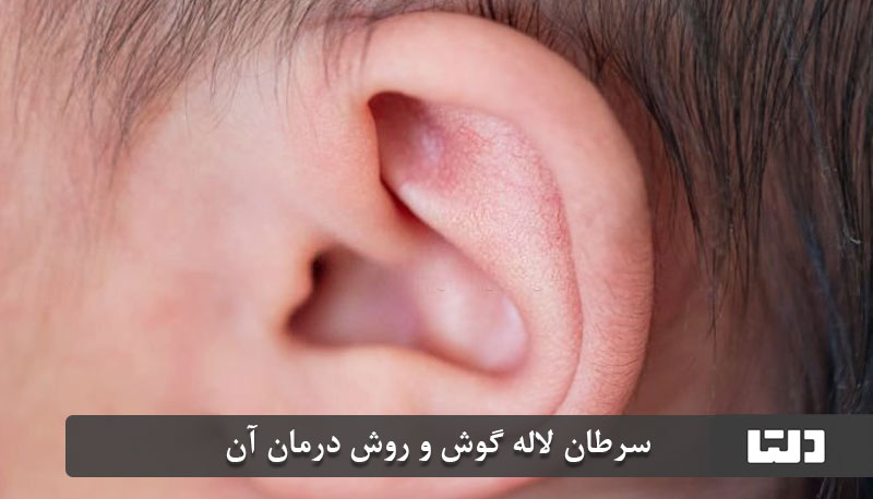 سرطان لاله گوش