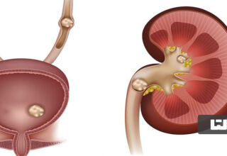 درمان سنگ کلیه
