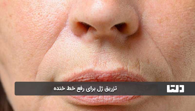 مزایای تزریق ژل برای خط خنده