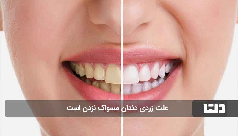 روش سفید کردن دندان