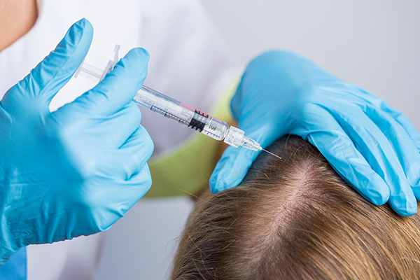 مزوتراپی؛ یکی از بهترین راه‌های درمان ریزش موی جلوی سر در زنان