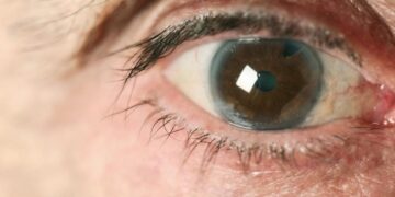 علت بوجود آمدن آب سیاه چشم -