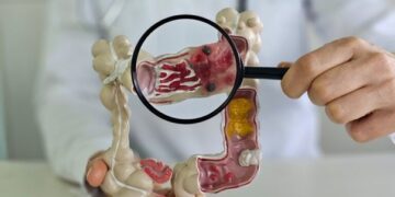 علائم سرطان روده چیست؟ نشانههایی که نباید نادیده بگیرید