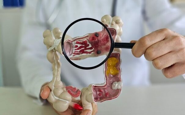 علائم سرطان روده چیست؟ نشانه‌هایی که نباید نادیده بگیرید