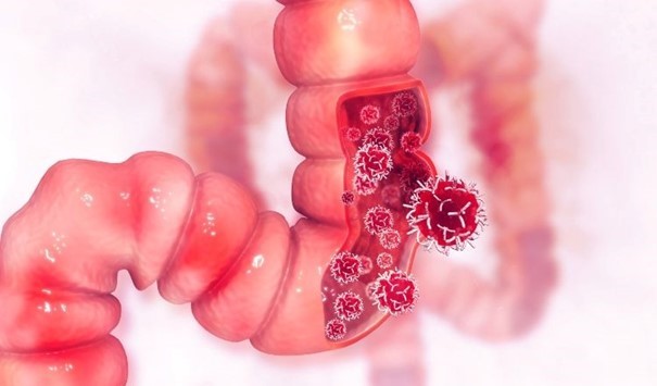 علائم عمومی سرطان روده که ممکن است به چشم نیایند